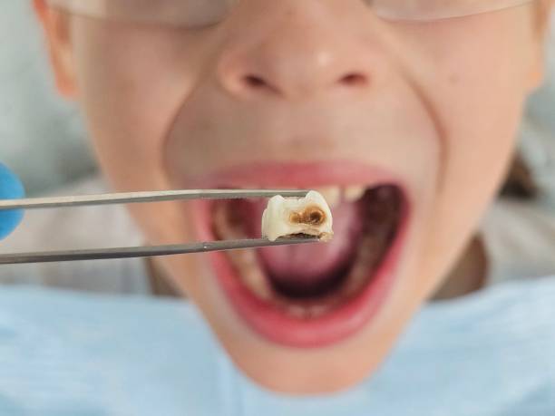 Best Dentist for Tooth Abscess  in Evans, GA